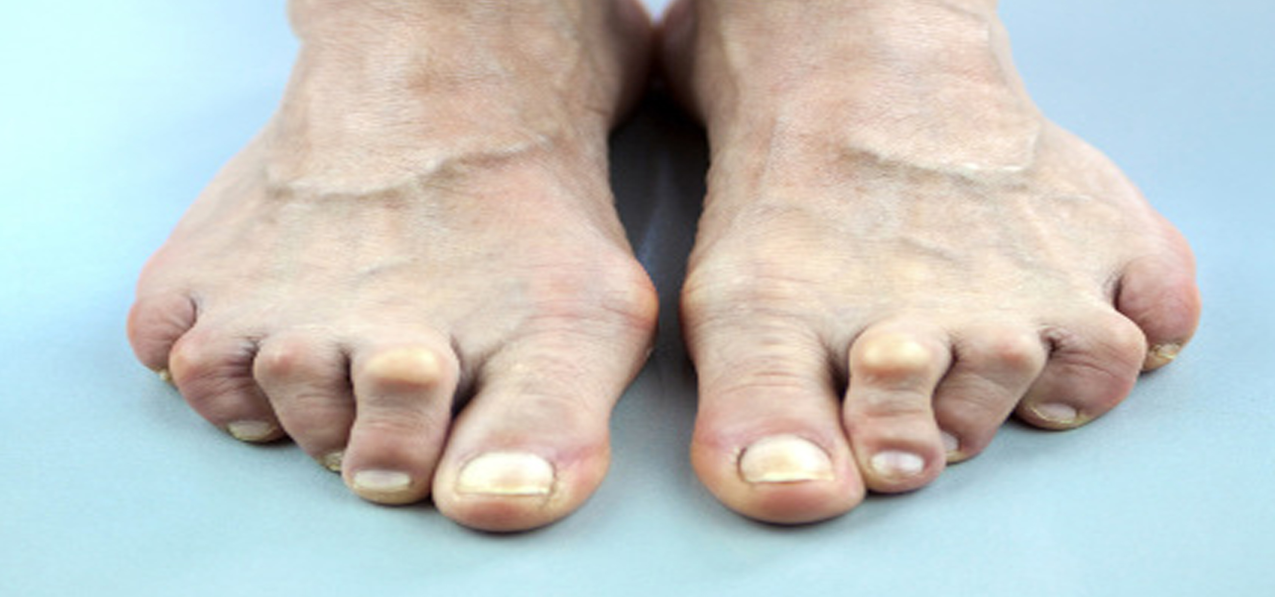 The Foot Surgery I Chiropody and Podiatry in Hornchurch, Essex
